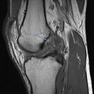 Torn ACL at the Femoral attachment