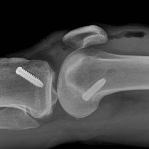 ACL reconstruction using 4-strand Hamstring Tendon graft fixed with screws at both ends