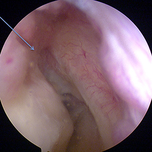 Empty Notch sign - seen arthroscopically after an ACL tear there is empty space at the site of ACL attachment to Femur