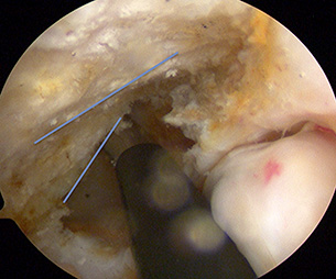 Right ACL Reconstruction - The blue lines are showing the resident’s ridge on the top and true posterior limit of the notch (lower line). It is important to identify the true posterior border of notch to help correct placement of ACL reconstruction tunnels.