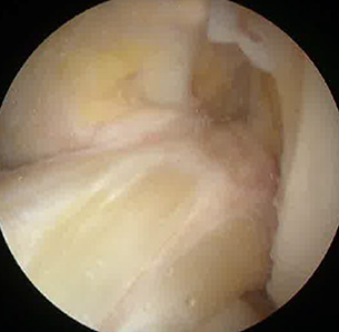 Dynamic testing of ACL at the time of arthroscopy