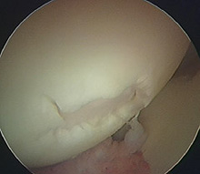 An area of gristle loss (osteochondral fracture) of the femoral head (hip ball)