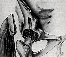 Arthrodesis with muscle pedicle graft davis 1954