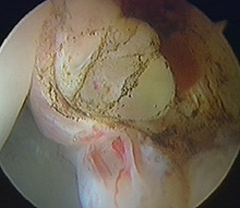 Cyst trying to burst out of the labrum (intralabral cyst)