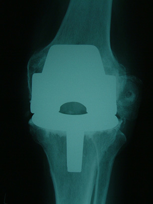 Dislocated Patella after Total Knee Replacement