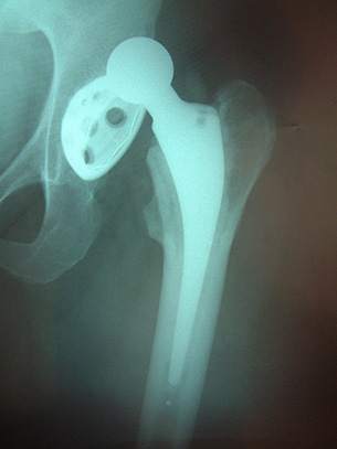 A dislocated total hip replacement – ouch! In fact, although this can appear to be a major problem at the time, the majority of patients come through one of these unscathed and without any significant troubles for the future.