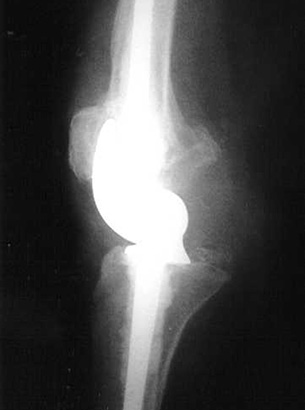 Hinged Knee Replacement