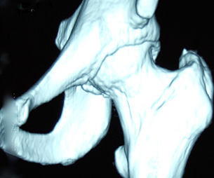 A three-dimensional CT scan showing a bump on the front of the hip ball. This is cam impingement.