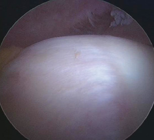 The bump as seen through a hip arthroscope (keyhole viewing device). The bump can be removed by this means.
