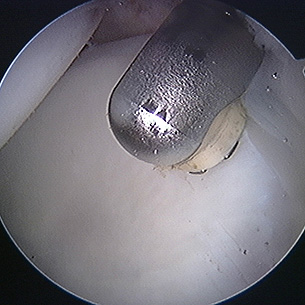 Using a radiofrequency probe in the hip