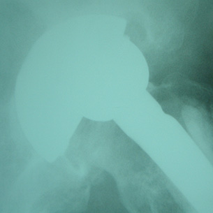 A failing total hip replacement. Look at how the ball (femoral head) of the artificial hip is lying eccentrically in the socket. This is because the polyethylene liner of the socket has become worn away and will need replacing.