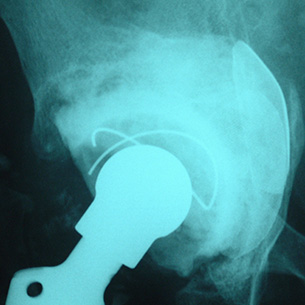 A revision total hip replacement showing the socket area filled with allograft bone (the dense, white area) in order to reconstruct lost bone stock created by the original hip replacement which had been in place for many, many years.
