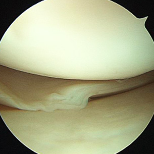 A torn medial meniscus (inner cartilage).
