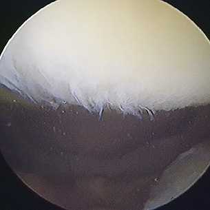 Early osteoarthritis of the back of the kneecap (patella).
