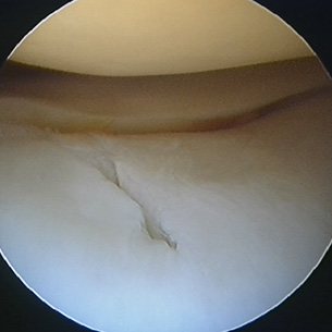 Large split found in the articular cartilage (gristle) of the knee at arthroscopy.