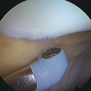 A radiofrequency probe being used to remove a small area of arthritic damage on the back of the kneecap (patella)