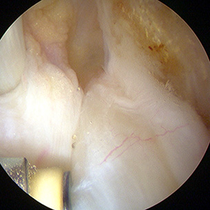 Left Knee arthroscopy