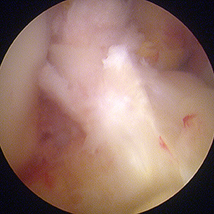 ACL reconstruction with LARS. Note the ACL stump is repaired as it shrouds the LARS ligament graft, which is invisible.