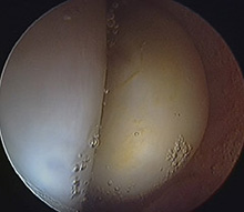 Lipoma (a benign tumour) of the hip joint