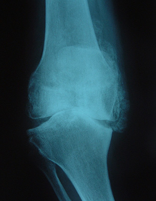 Osteoarthritic Knee X-ray