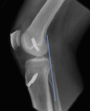 11-months post PCL/PLCLARS Reconstruction