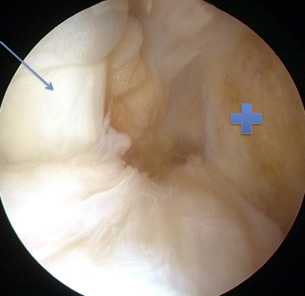 Normal PCL (blue arrow) and the torn ACL (+) from its attachment on the Femur
