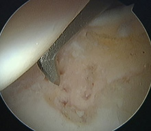 Performing a microfracture of an area of articular cartilage (gristle) loss