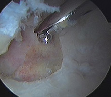 Removing osteoarthritis (central osteophyte) from the acetabulum (hip socket)