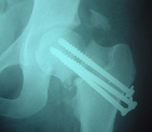 Screws in Hip Fracture