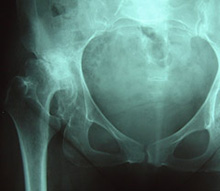 Severe Osteoarthritis in Dysplastic Hip