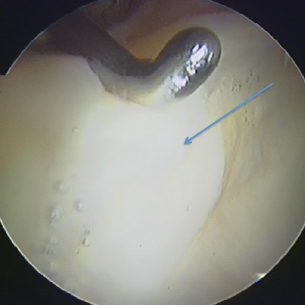 Left Knee arthroscopy