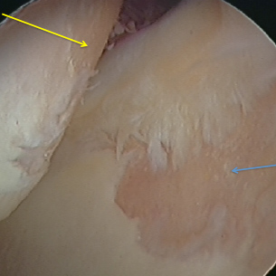 Left Knee arthroscopy