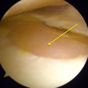 Left Knee arthroscopy