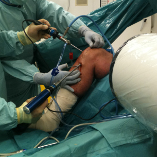 Left Knee arthroscopy