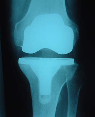 Unconstrained Total Knee Replacement